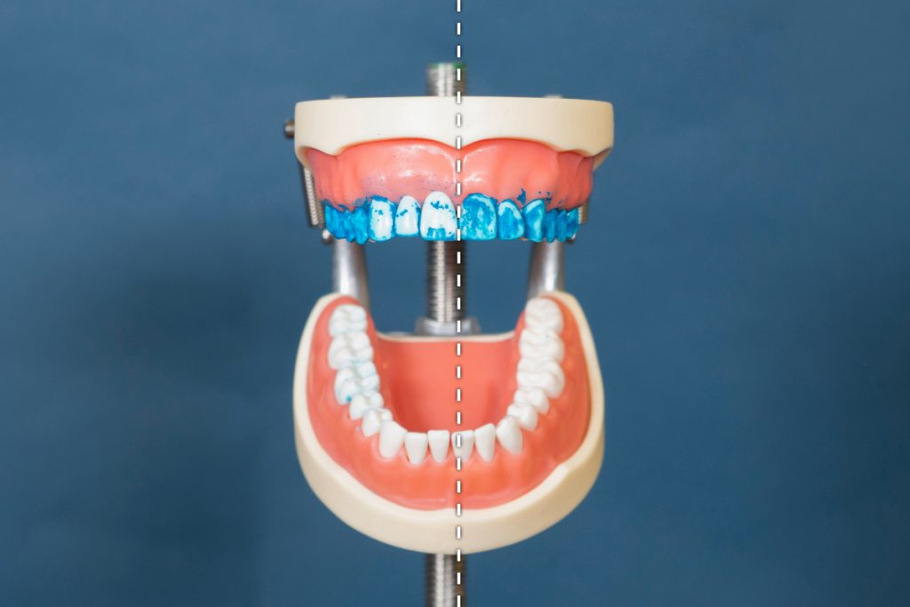 Modell-Gebiss vor blauem Hintergrund mit blauer Paste an Zähne