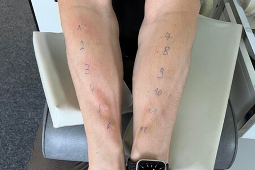 Allergie-Test mit Tröpfchen auf zwei Unterarmen