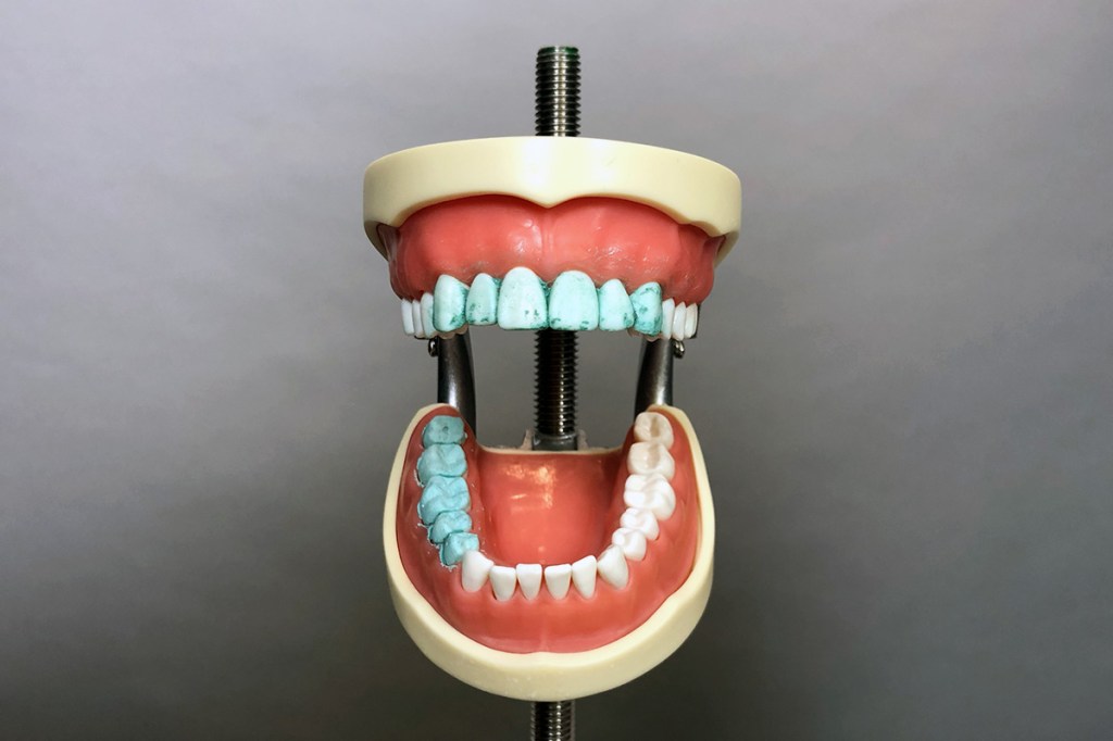 Das Zahnmodell nach dem Putz-Test von vorne.