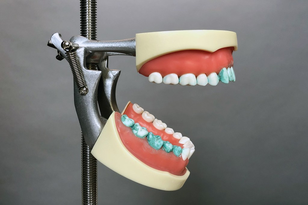Das Zahnmodel nach dem Putz-Test von der Seite.