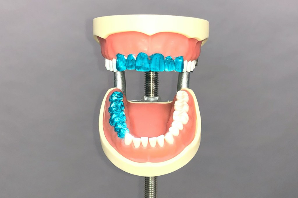 Das Zahnmodell vor dem Putz-Test von vorne.